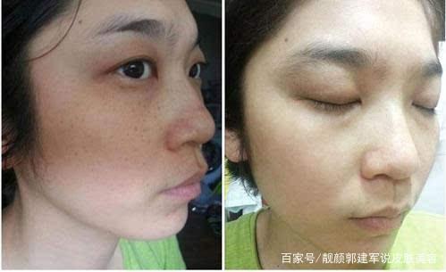 祛斑留疤痕美容反变“丑”该怎么办?