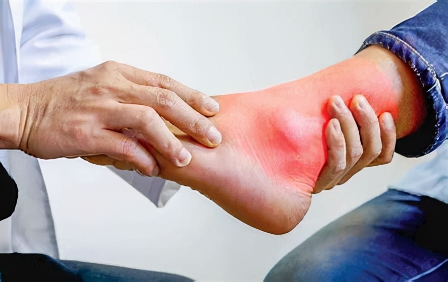 得了痛风需要注意哪些,痛风发作是要多走路还是少走路