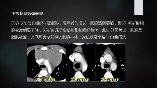 胸腺增生和纵隔肿瘤的区别和症状,纵隔胸腺肿瘤的常见临床症状表现