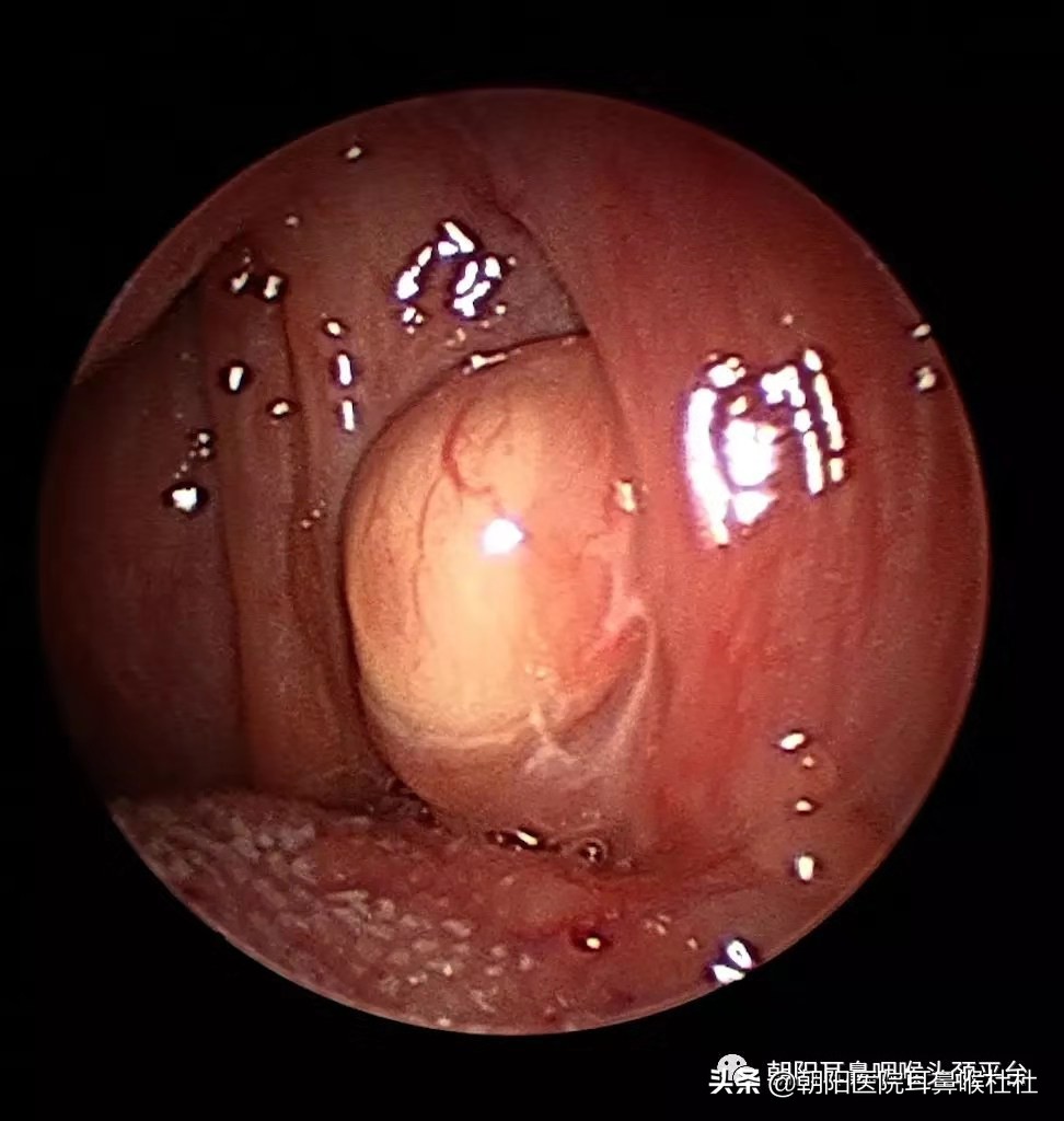 别拿扁桃体发炎不当回事