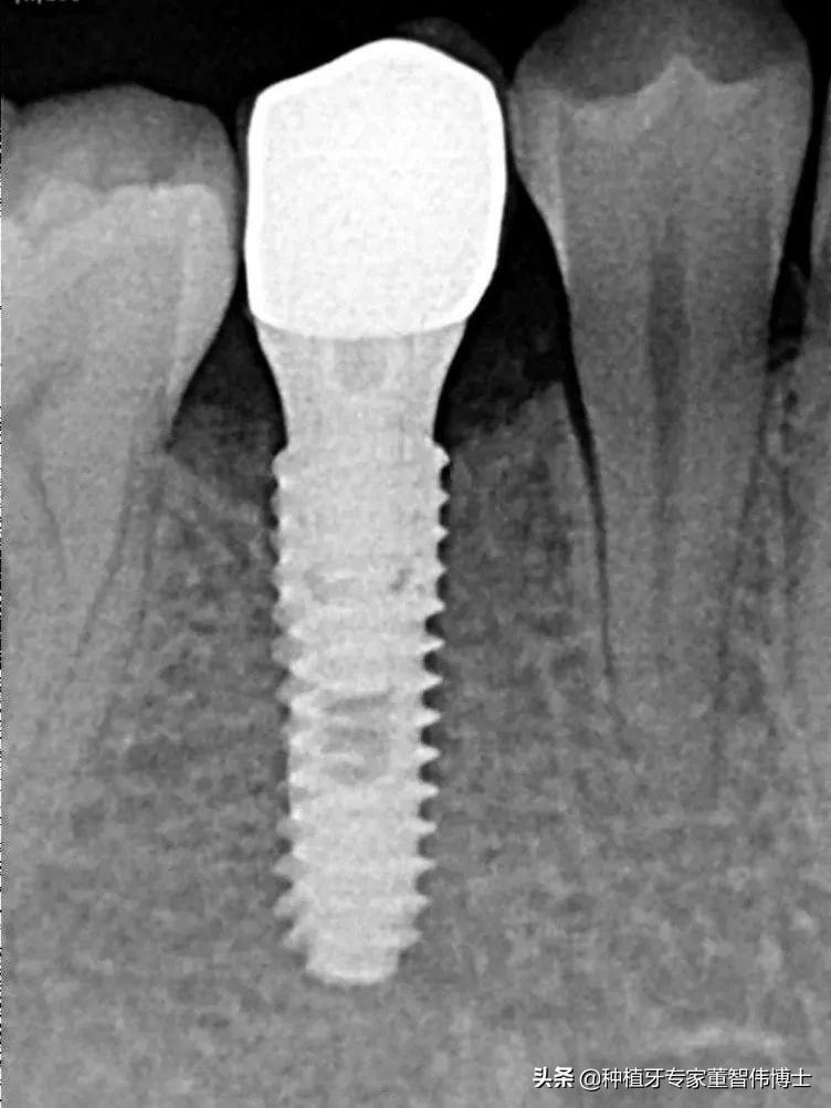 拔牙后即刻种植好还是延期种植好,拔牙后牙槽骨突的修复术视频