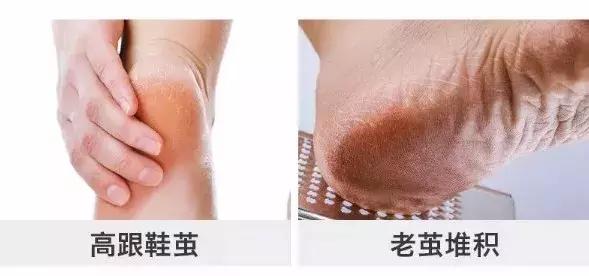 啊呀！你的脚后跟看起来糙得像位“真正男子汉”