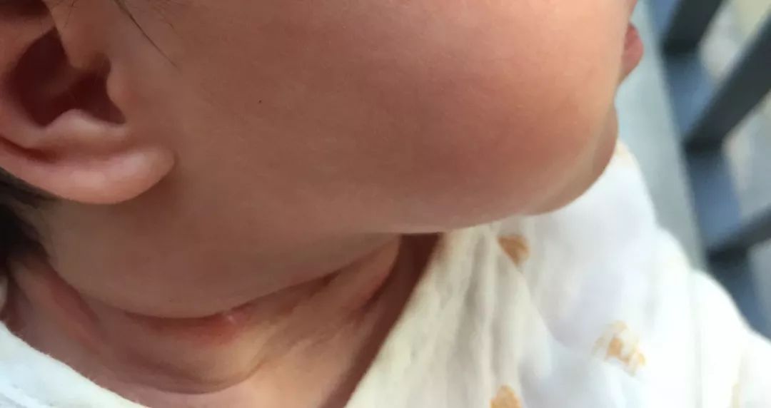 宝宝出现淹脖子怎么办,胖宝宝淹脖子怎么护理