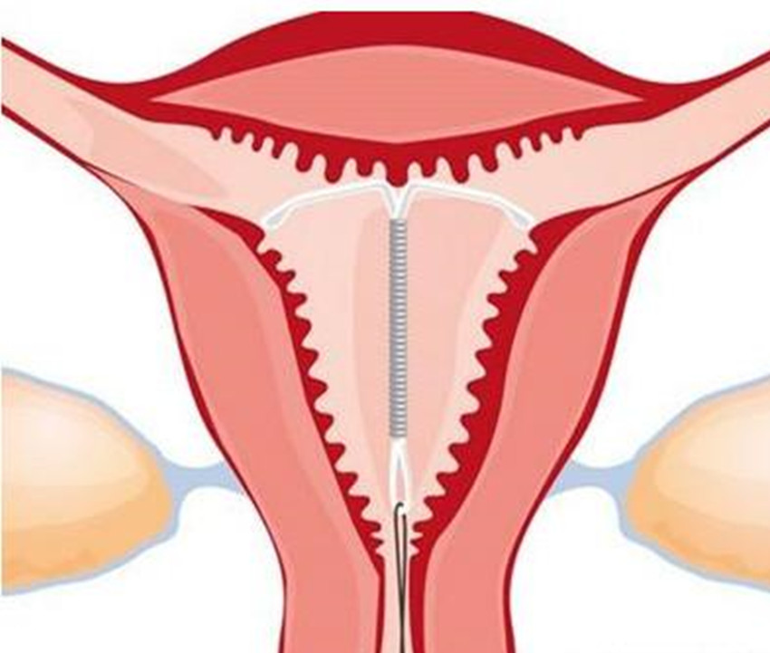 带环会怀孕的宝宝能要不,带环怀孕的孩子到底能要不能要