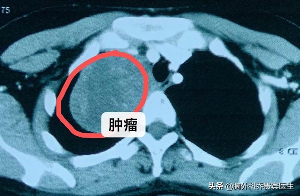 年轻妈妈孕期右手臂疼痛，原来右颈胸长了巨大肿瘤