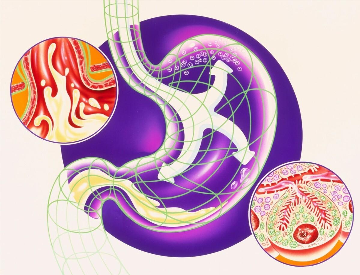 胃反酸中医怎么调理最有效,胃反酸怎么快速缓解