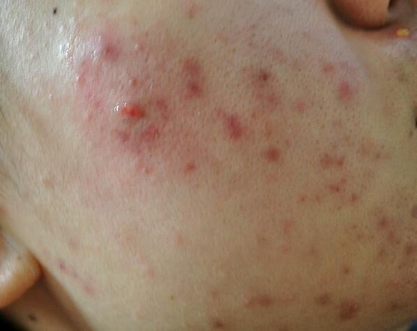 痘痘反复长？不内调再大牌的护肤品都没效果，这三招帮你远离痘痘