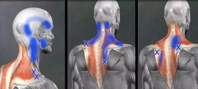 有种伤不起的痛叫筋膜炎,筋膜炎疼痛的原因和治疗方法