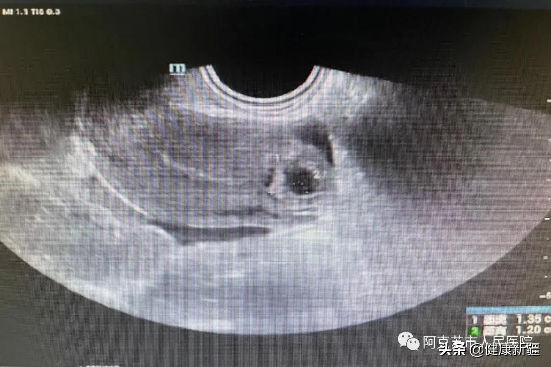 阿克苏地区第一人民医院超声科,阿克苏地区人民医院超声科