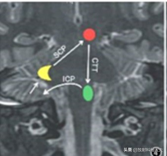 脑出血几年以后复发,脑出血几年后偏瘫越来越严重