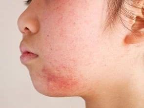 敷完面膜为啥长出来一个痘,敷了面膜皮肤还是掉皮