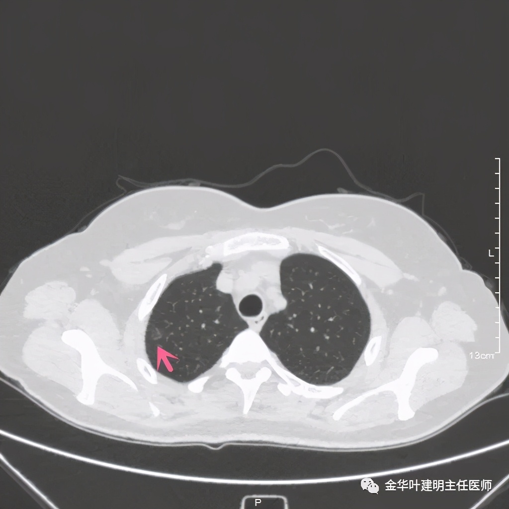 左肺上叶在ct影像上怎么看,平扫ct可以看出肺肿瘤的变化吗