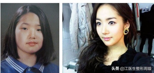 瘦脸针敢不敢打,瘦脸针不要随便打