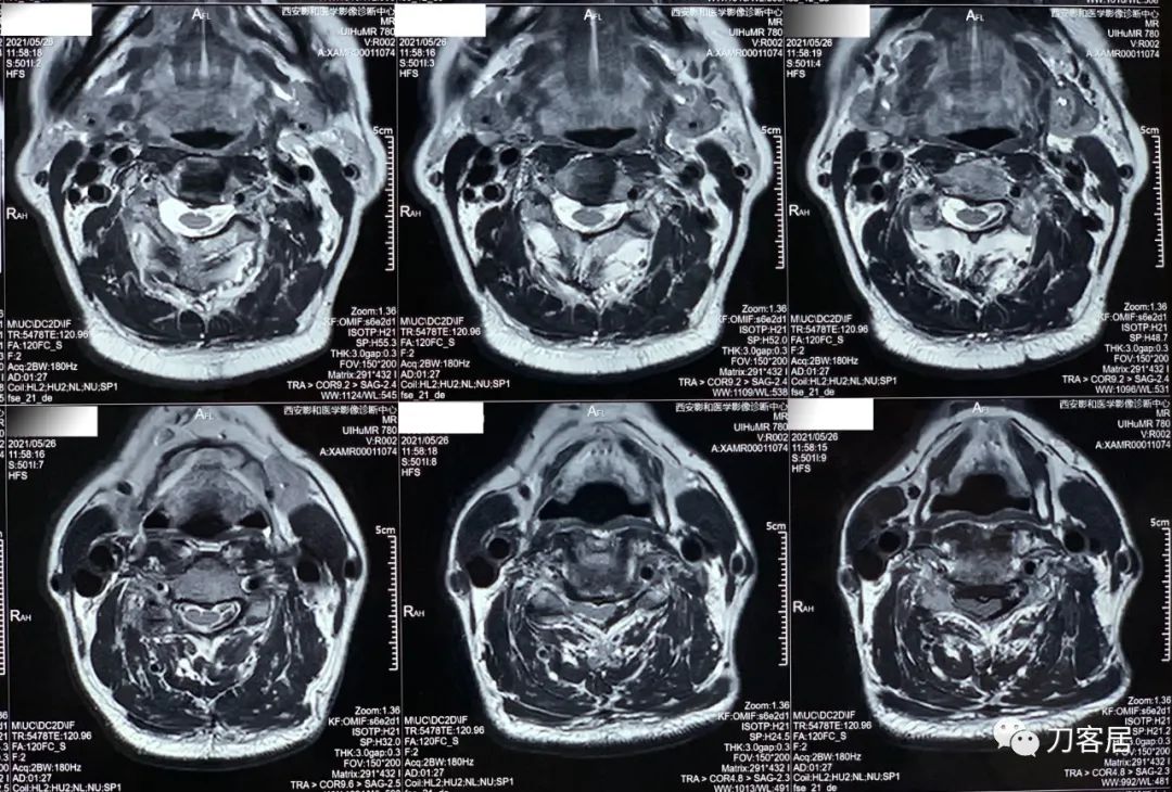 颈椎病椎间盘突出医生说先不手术,颈椎3-7节椎间盘突出怎么治疗