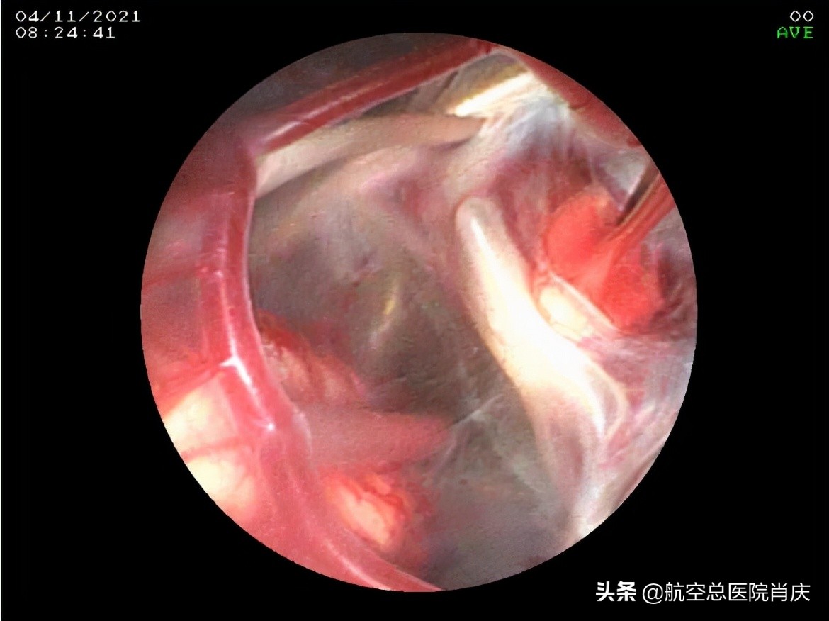 鞍上池蛛网膜囊肿手术费用,鞍上池蛛网膜囊肿影响智力吗