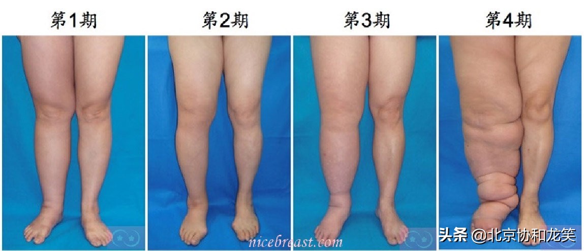 淋巴水肿哪个医院治疗最好,淋巴回流障碍性水肿怎么治疗