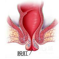 排便时，肛门掉出个小肉球，不痛不痒消不掉，4个小方法帮你缓解