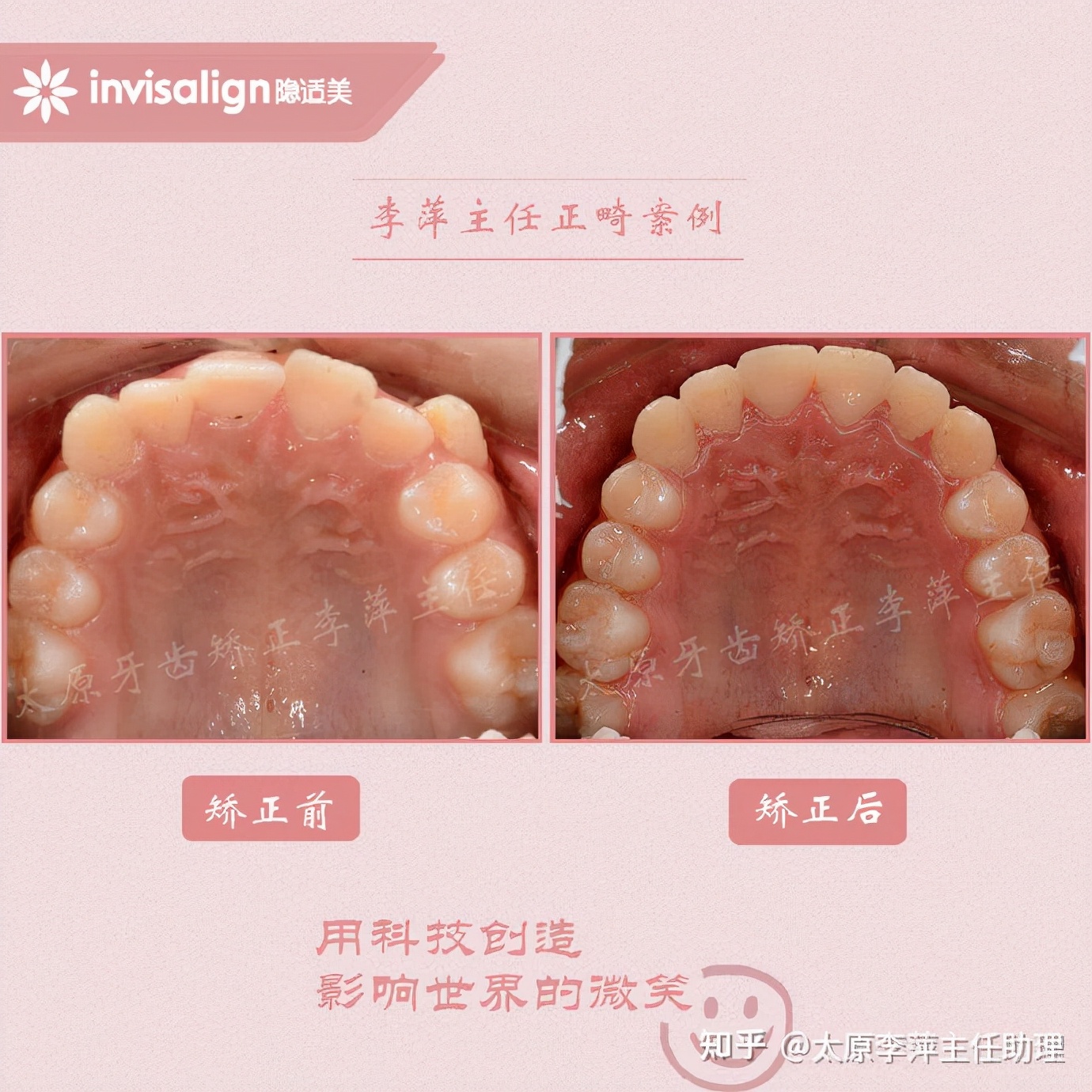 太原牙齿矫正靠谱吗,太原成人隐形牙套牙齿不齐