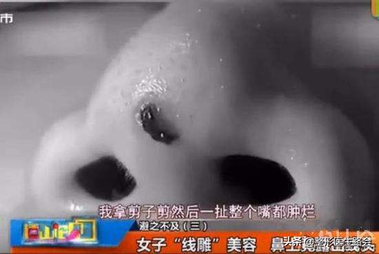 为什么不建议做线雕手术,为什么不推荐做线雕鼻