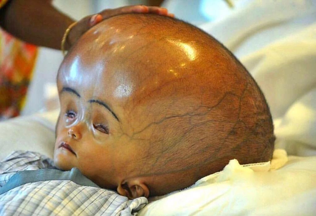 孩子的头偏小怎么办,孩子扁头偏头