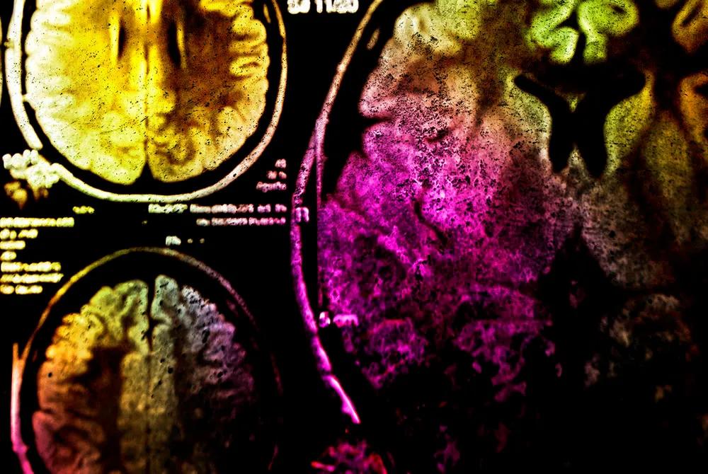 上海新华医院李世亭,新华医院神经外科李世亭