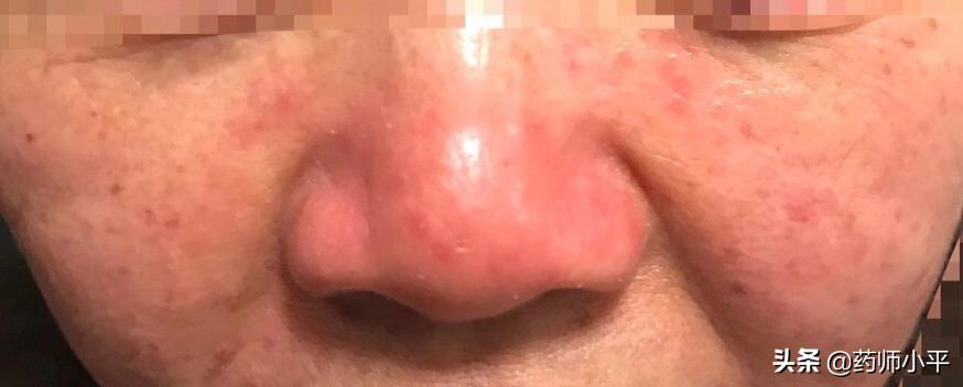 脸部反复过敏跟螨虫有关吗,脸因为螨虫过敏怎么治疗