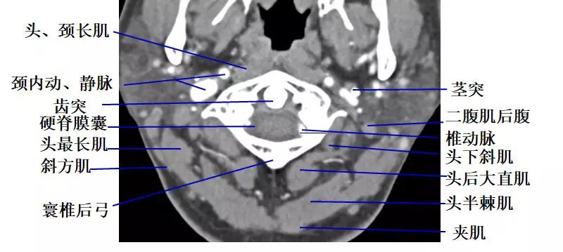 颈椎腰椎疾病ct及mri诊断,腰椎ct可以发现肠部病变吗