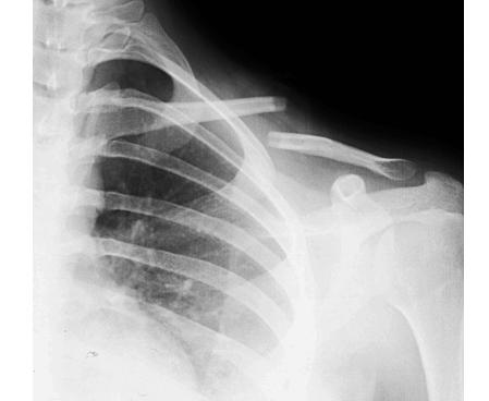 锁骨保守治疗有可能治愈吗,成年人锁骨断了必须要动手术吗