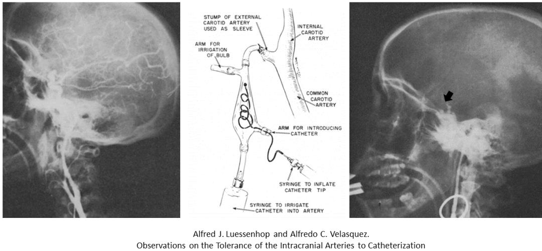 颅内动脉瘤血管栓塞治疗术后护理,颅内动脉瘤手术后血管渗血