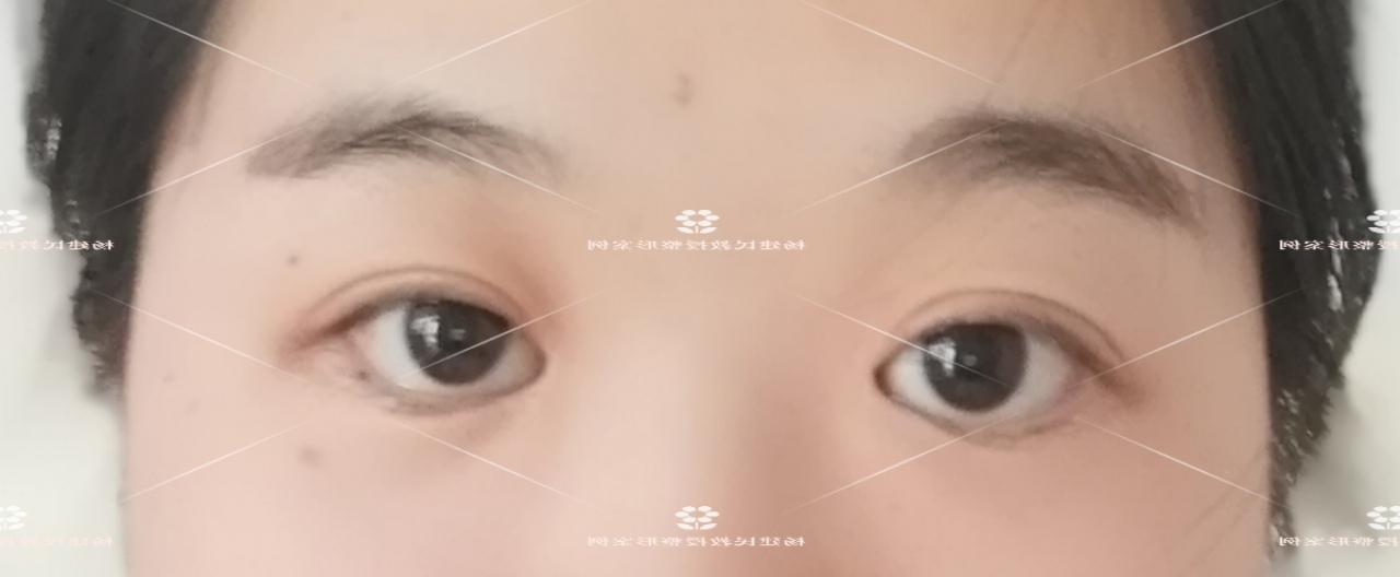 眼睑内翻倒睫治疗方法,老年人倒睫最快的治疗方法