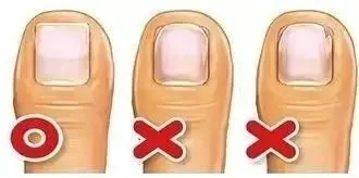 指甲老往肉里长化脓,指甲为什么一直往肉里长