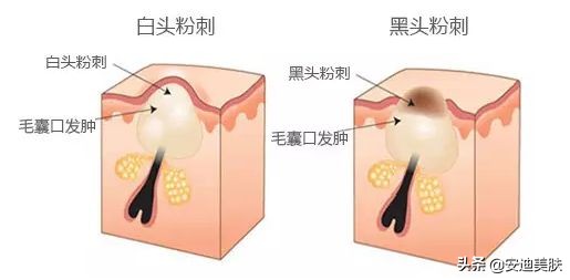 男生鼻子黑头去除小妙招,小学学生鼻子长黑头如何快速去除