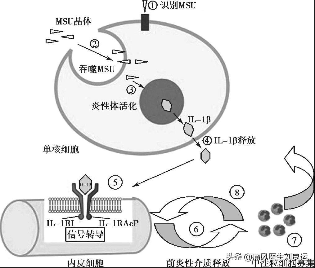 脚很痛不知道是扭伤还是痛风,脚痛不肿怎么判断是不是痛风