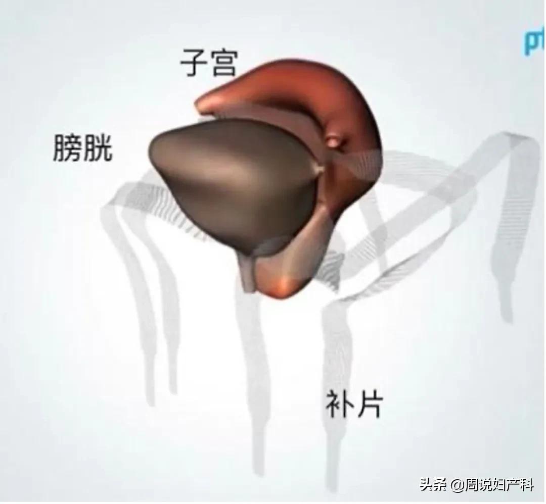 生完孩子憋不住尿怎么办,生完孩子憋不住尿怎么回事