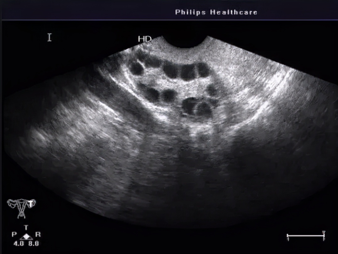 生完娃体检出现卵巢囊肿,卵巢囊肿可以通过教育局体检吗