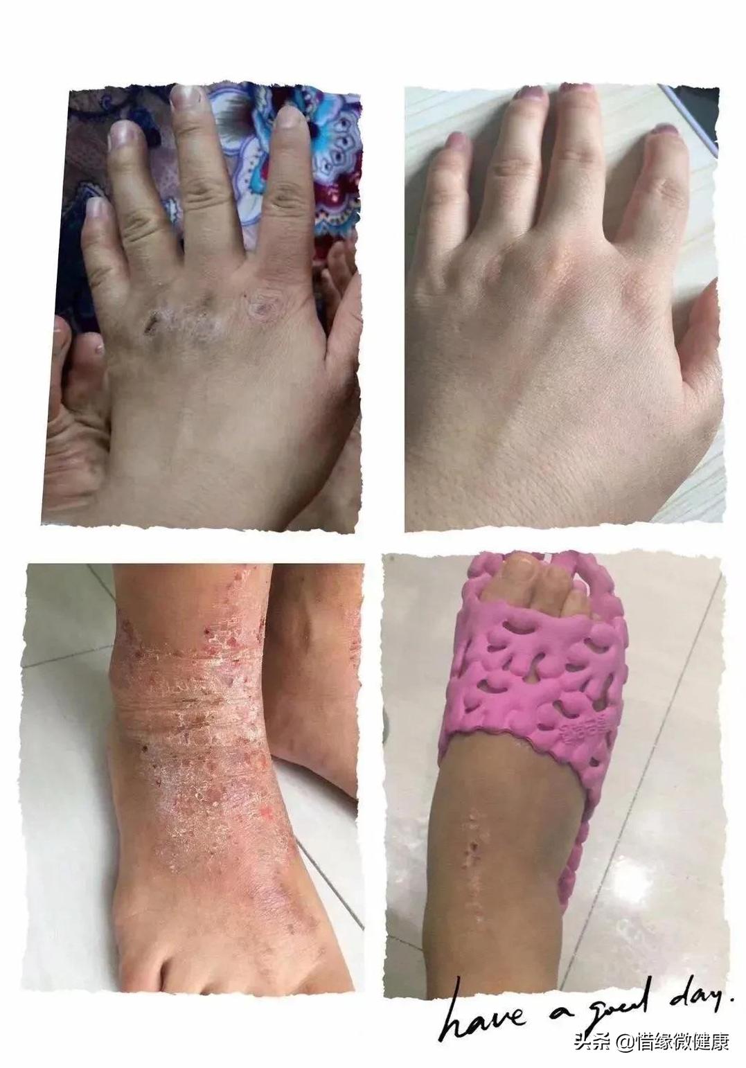 10年湿疹治不好怎么办,10年皮肤病无法根治怎么办