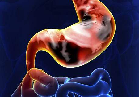 浅表性胃炎溃疡糜烂的症状有哪些,糜烂性胃炎的舌头会出现哪些症状