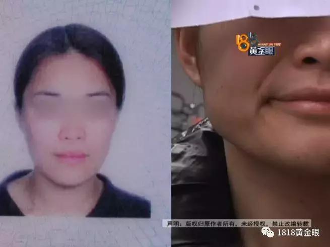 打完瘦脸针青蛙腮正常吗,打完瘦脸出现青蛙腮