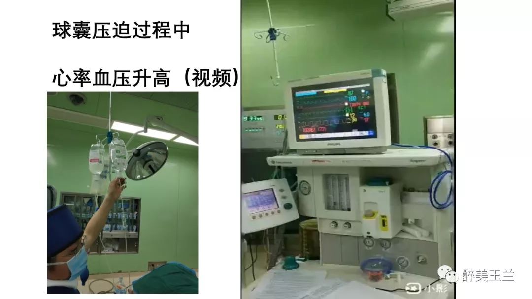 病例分享丨三叉神经节微球囊压迫术的麻醉管理