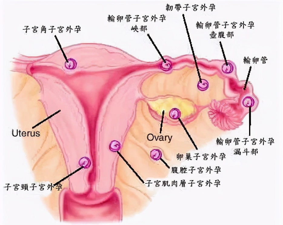 对“死神”说：放开那女孩！——妇科成功抢救异位妊娠患者