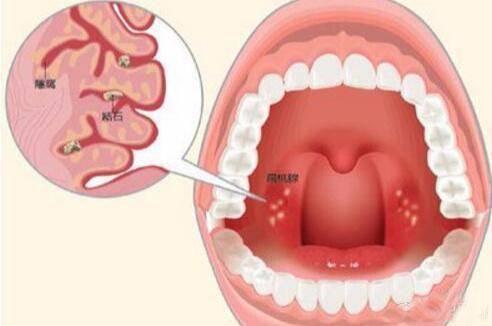 入秋了有一点咳嗽吃什么好得快,嗓子干燥疼痛后咳嗽是什么阶段