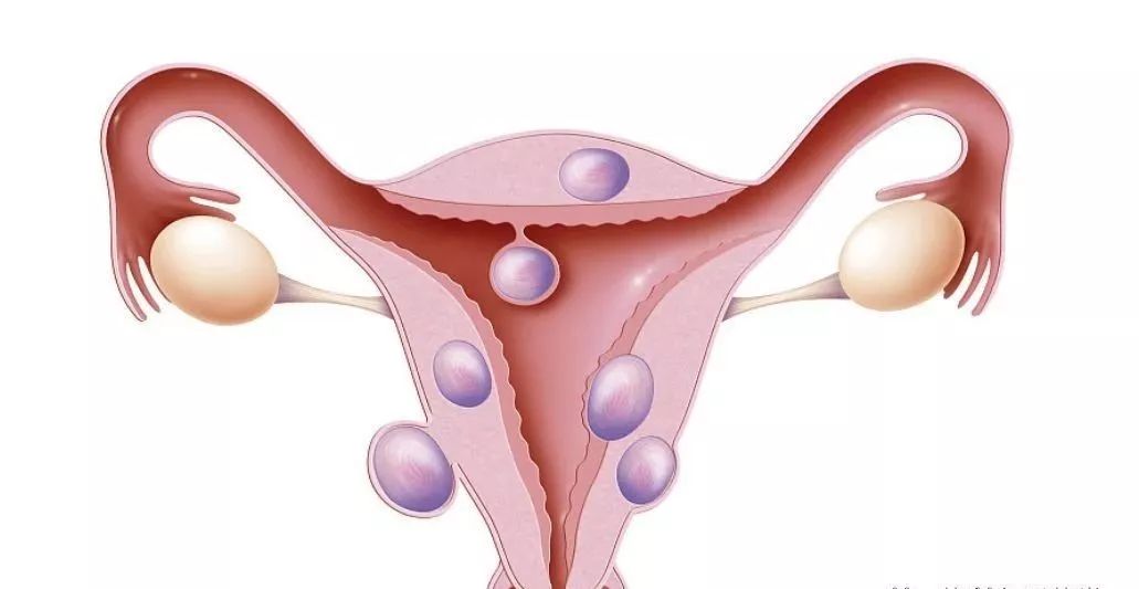 子宫肌瘤向外突出影响月经吗,子宫肌瘤影响月经淋漓不尽咋办