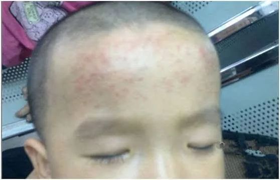 多少家长被退热贴骗了,退热贴真的没用吗