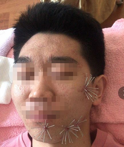 屏障受损起闭口粉刺多长时间能好,不要小看了闭口粉刺