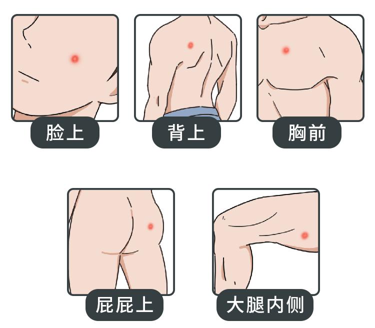 不同部位长痘痘的原因及解决方法,不同地方长痘痘的原因和改善方法