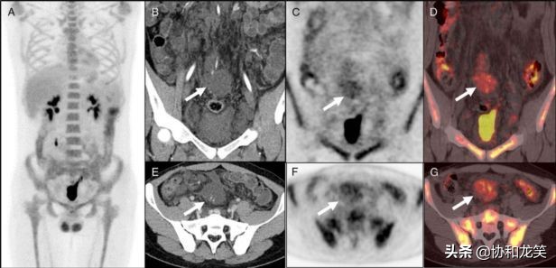 淋巴管瘤在68Ga-NOTA-EvansBluePET/MRI上的表现