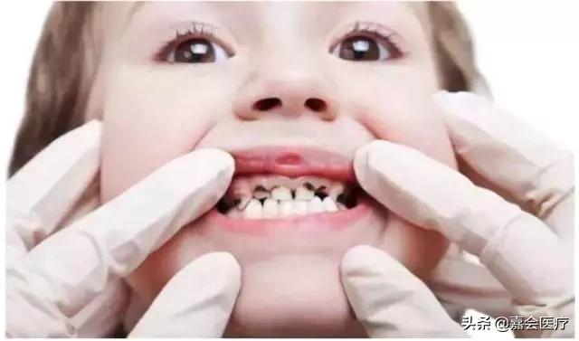 刷完牙用牙线清理牙垢多余吗,刷牙只能清洁70%的牙齿