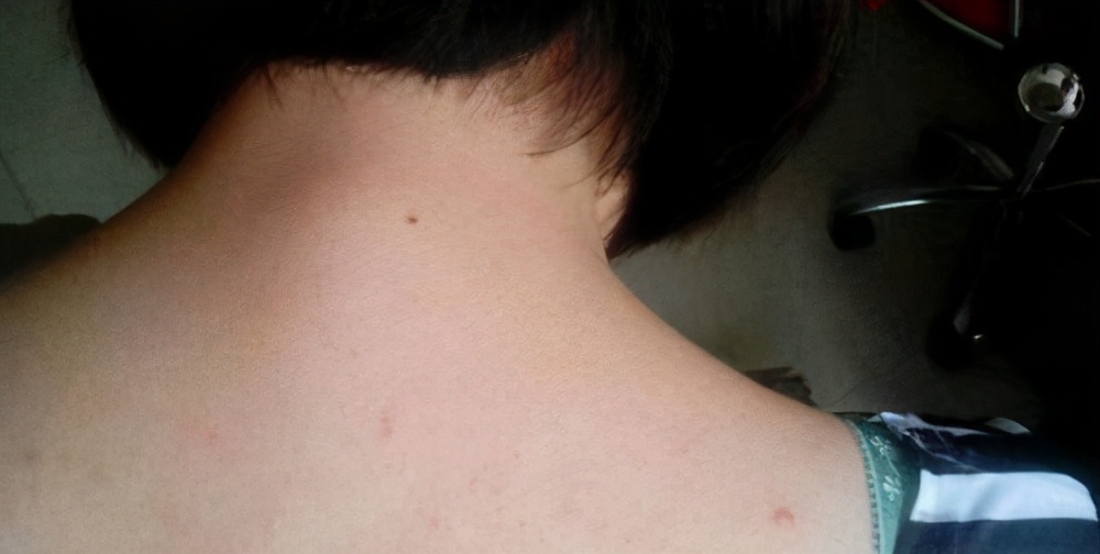 男生胸前背后长痘痘怎么治疗,胸前背后长痘痘流脓怎么解决