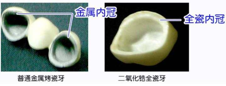 牙冠的常见种类与区别,牙冠什么种类性价比高