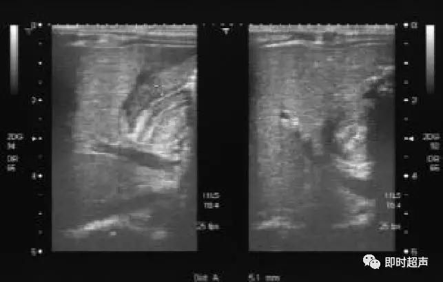 小儿消化道急症超声